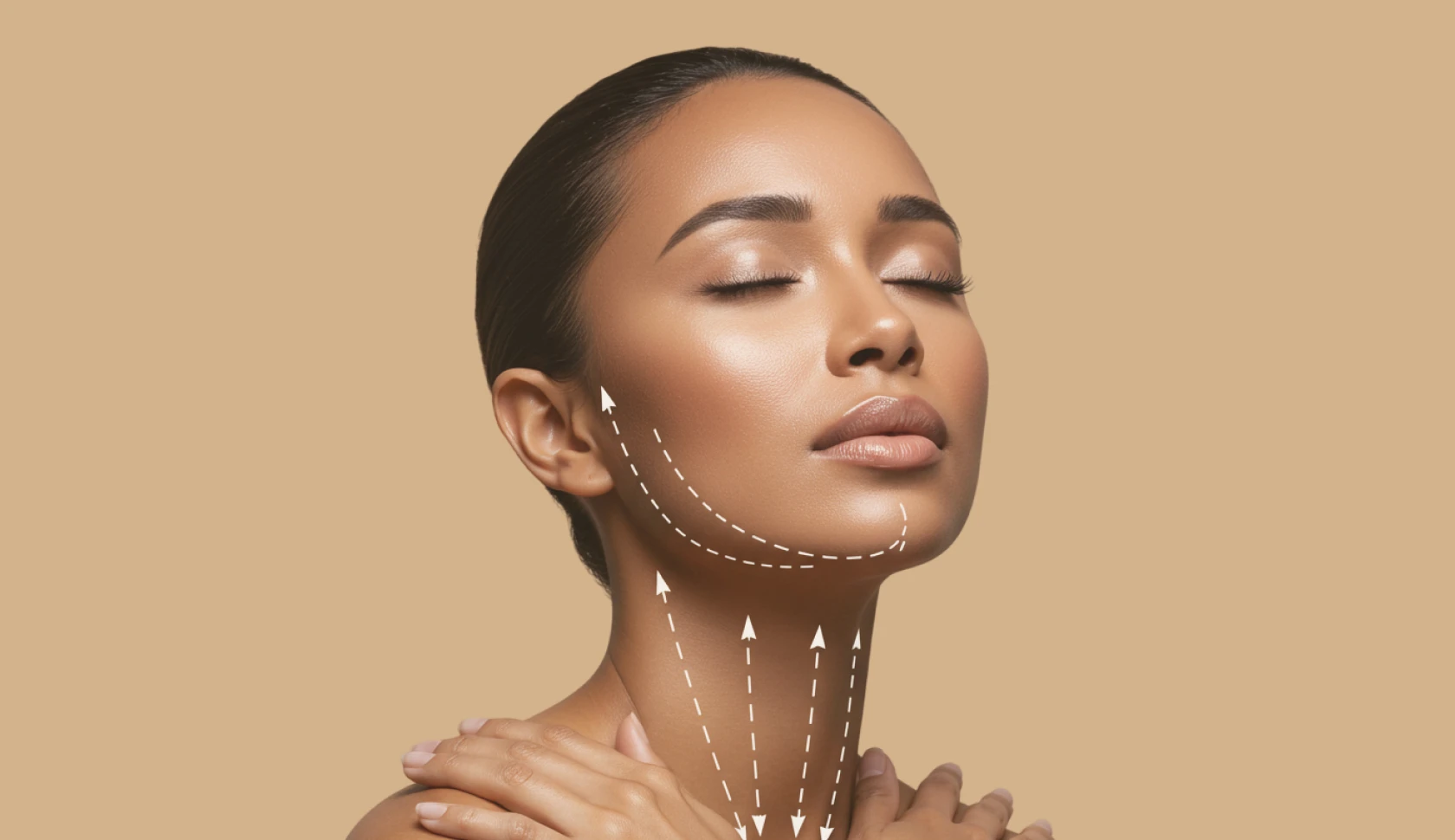 Aplicação de fios de PDO para estímulo de colágeno e efeito lifting facial imediato em João Pessoa pela Dra. Ana Paula Pontes.