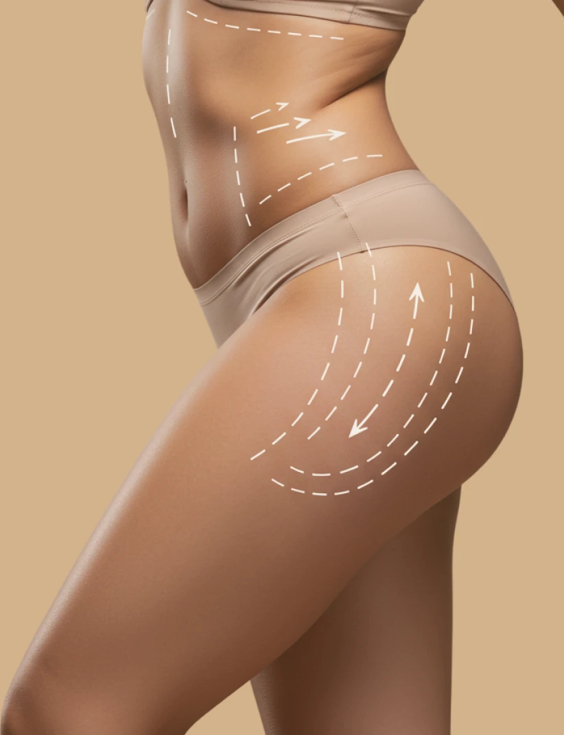 Tratamento injetável para redução de gordura localizada no culote e melhora do contorno corporal em João Pessoa, clínica Dra. Ana Paula Pontes.