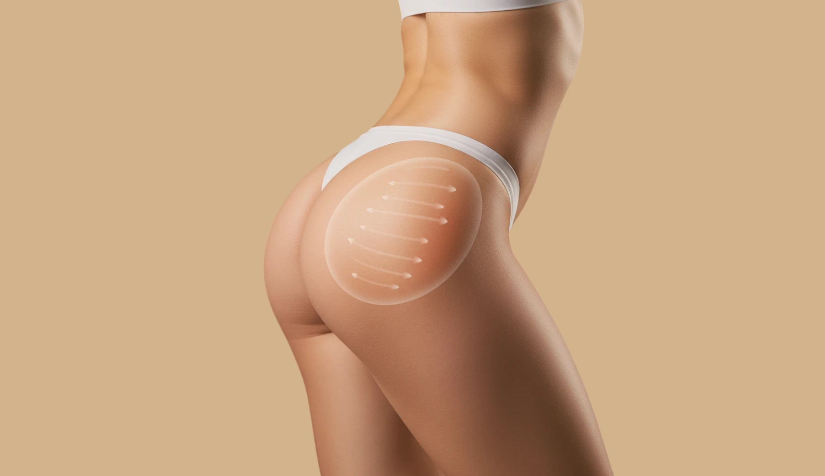 Procedimento de harmonização glútea com bioestimuladores para melhora da projeção e firmeza na clínica de estética da Dra. Ana Paula em João Pessoa.